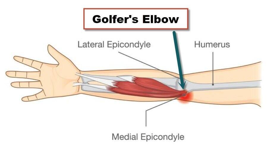 Golfers Elbow Explained