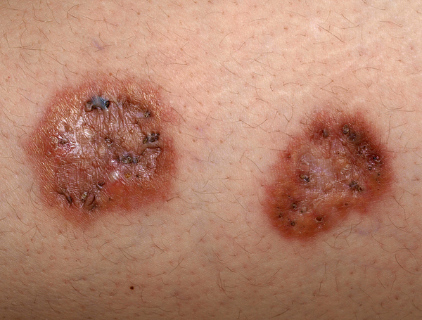 Skin lesions due to diabetes