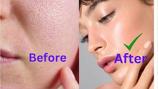 How Can I Naturally Treat Open Pores at Home?