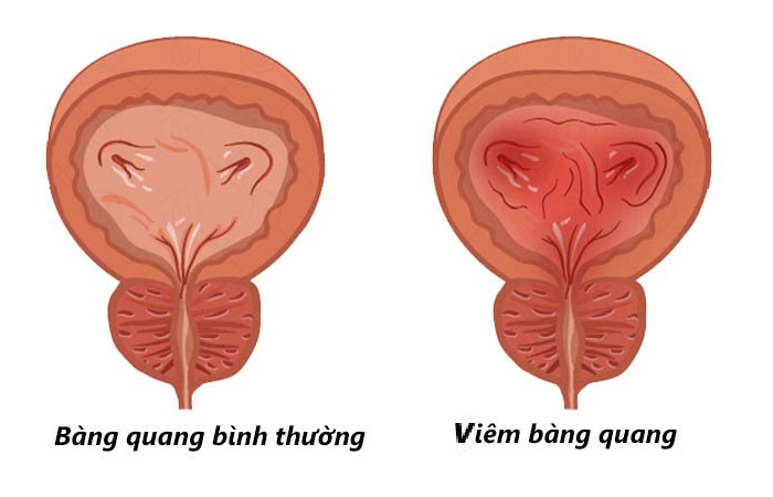 Viêm bàng quang là bệnh nhiễm trùng tiết niệu khá phổ biến và đang có dấu hiệu gia tăng