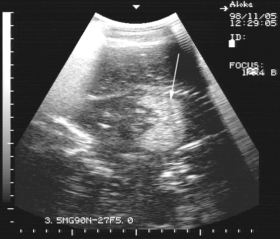 Ultrasonogram of an equine fetus 24 hours after fetal injection. Note the hyperechoic region in the cranial abdomen of the fetus (arrow).