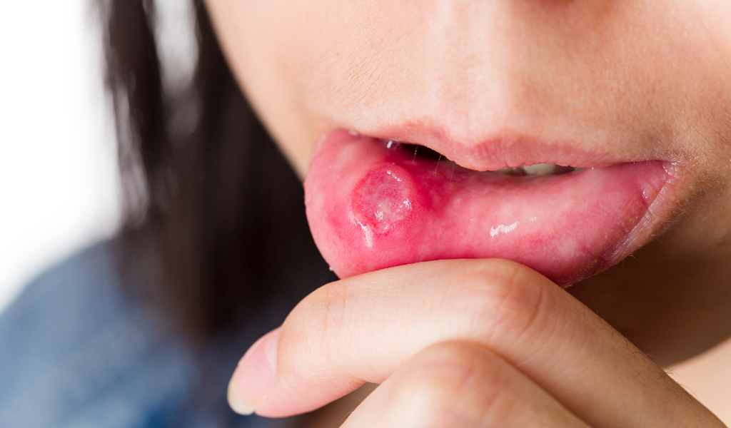 Nhiệt miệng thể Herpes