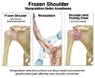 frozen-shoulder-manipulation - Complete Spine and Pain Care