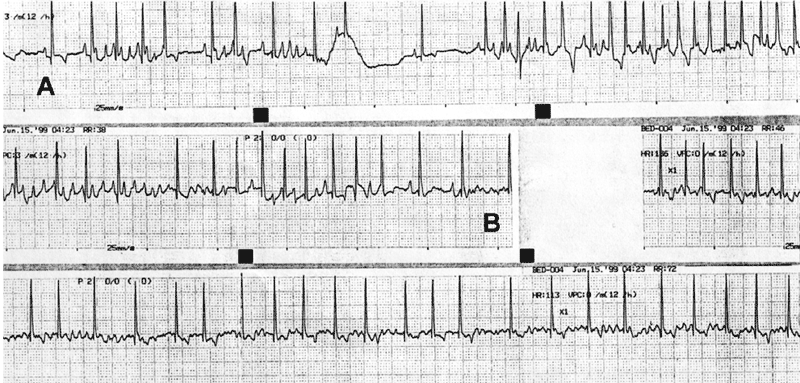 Continuous ECG rhythm strips obtained from a Labrador retriever during the early postoperative period following hemilaminectomy