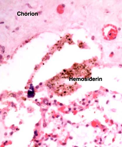 Bontebok placenta with old hematoma beneath chorion