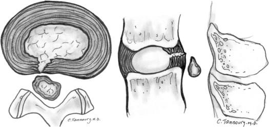 Herniated disc: sequestration. (Left) Axial and (Right) sagittal images...  | Download Scientific Diagram
