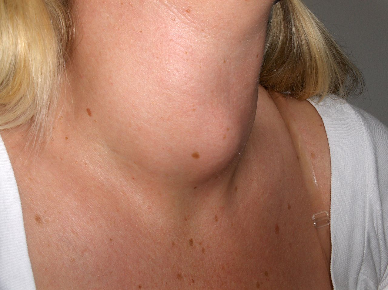 Hypothyroidism caused by under use of iodine can cause goiter to develop on the throat.
