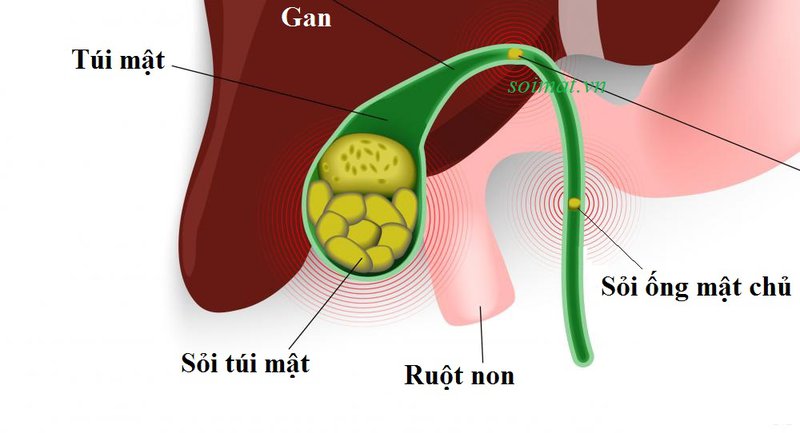 Ngăn ngừa hình thành sỏi túi mật bằng hạt óc chó