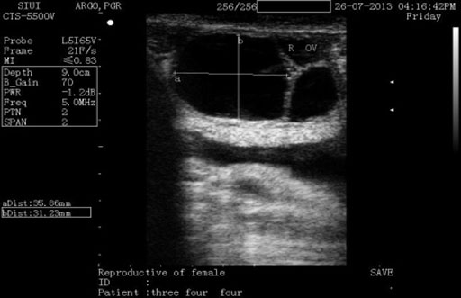 Transrectal ultrasonogram of a buffalo with a follicular ovarian cyst.