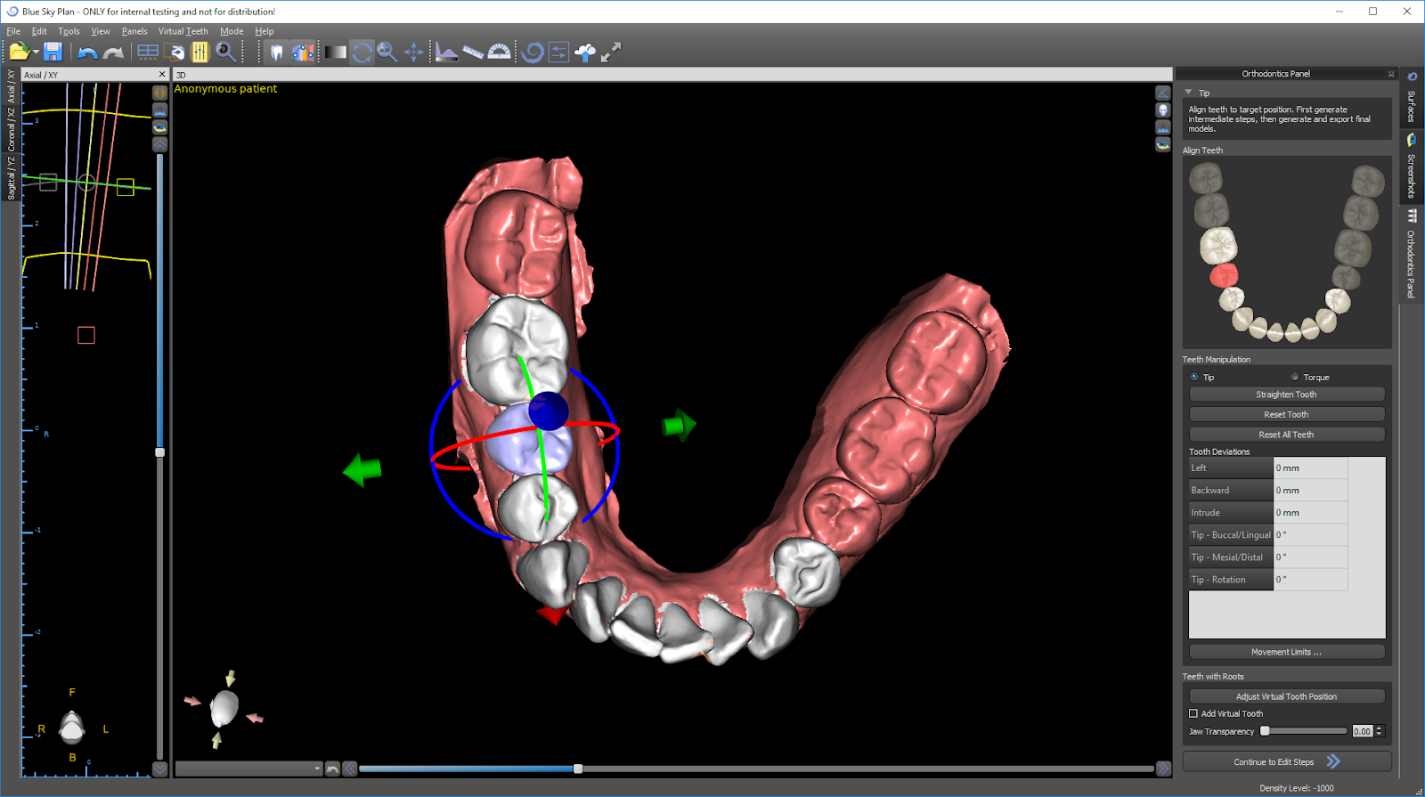 Blue Sky Plan Orthodontic Tooth Alignment