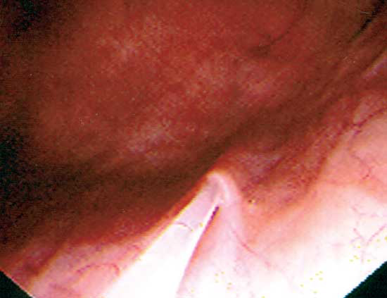 To collect urine from a ureter, polyethylene tubing is advanced from the biopsy port of the endoscope through the ureteral opening