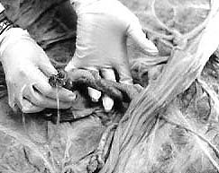 Insertion of umbilical cord