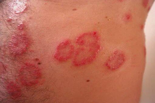red rashes on the skin due to a psoriasis skin condition