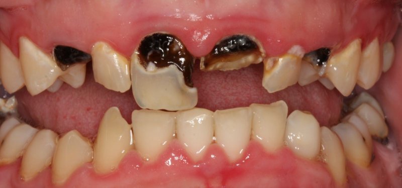 Vi khuẩn tích tụ lâu ngày gây sâu răng