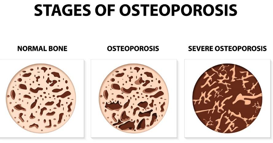 Osteoporosis affects roughly 40 million Americans | Information provided by  Spine Nevada in Reno, Sparks and Carson City