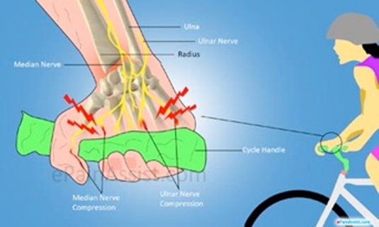 Riding with the incorrect mountain bike handlebar sweep can lead to injuries such as handlebar palsy. 