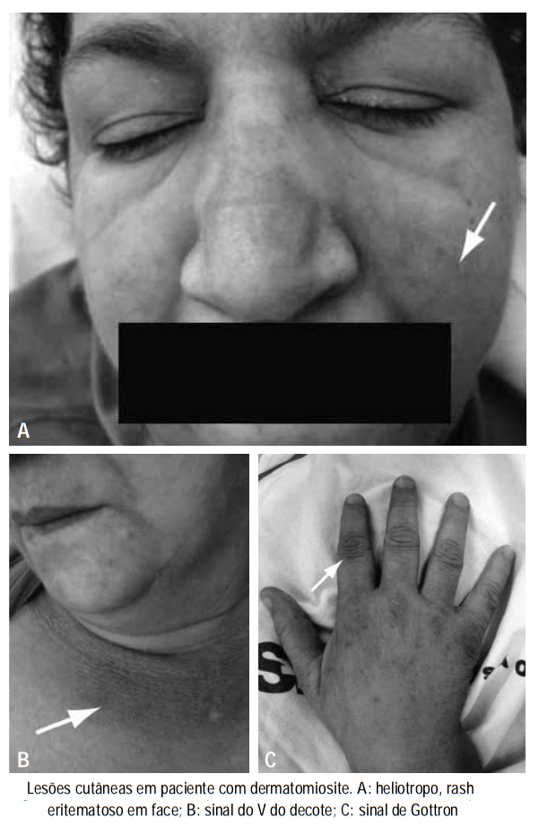 Lesões cutâneas em paciente com dermatomiosite: heliotropo, rash eritematoso em face, sinal do V do decote e sinal de Gottron