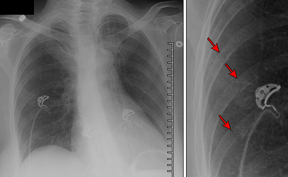 Figura 3: Radiografia de tórax evidenciando fraturas costais. Disponível em: https://www.uptodate.com/contents/initial-evaluation-and-management-of-rib-fractures?topicRef=353&source=see_link. (tórax instável)