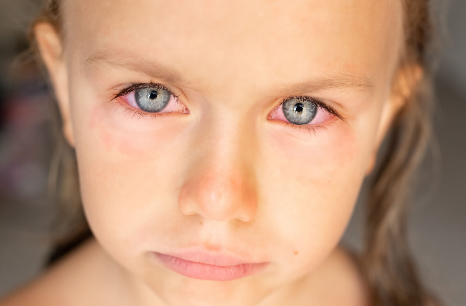 A close-up of a kid with redness in her eyes possibly caused by allergies.