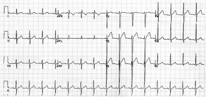 eletrocardiograma normal