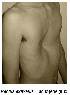 pectus_excavatum2
