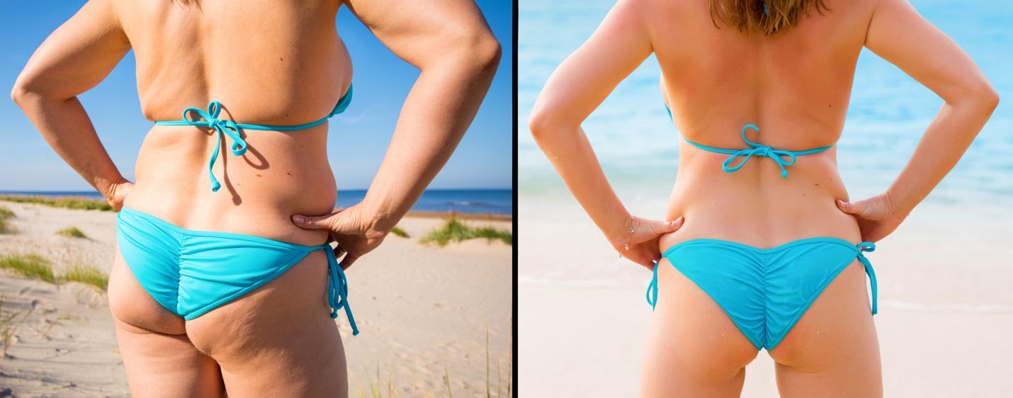 Body sculpting procedures can include a butt lift or thigh lift to improve your appearance 
