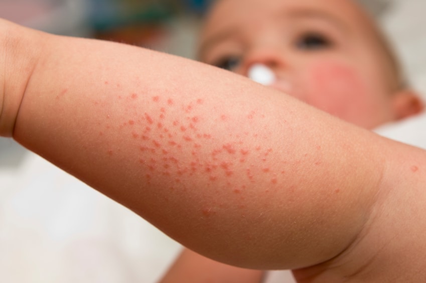 حساسية الجلد عند الأطفال