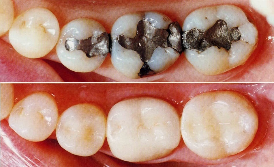 before and after pictures of teeth that used to have silver amalgam fillings