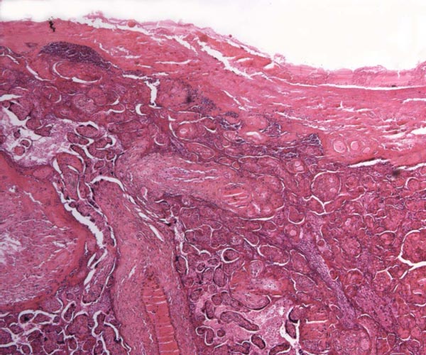 Histologic appearance of the infarcted placental tissue