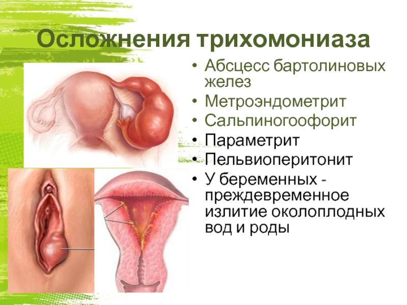 чем лечить вагинальные инфекции