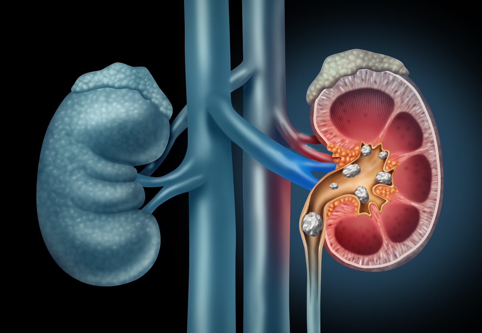 Image depicting kidney stones
