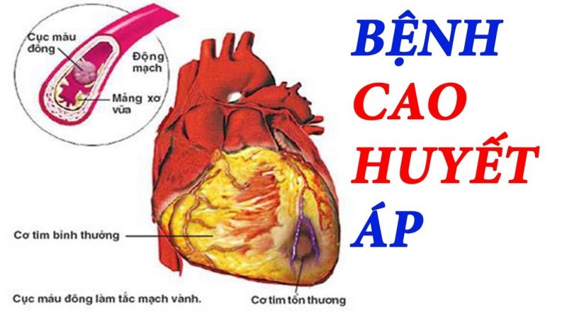 Biến chứng nguy hiểm do cao huyết áp