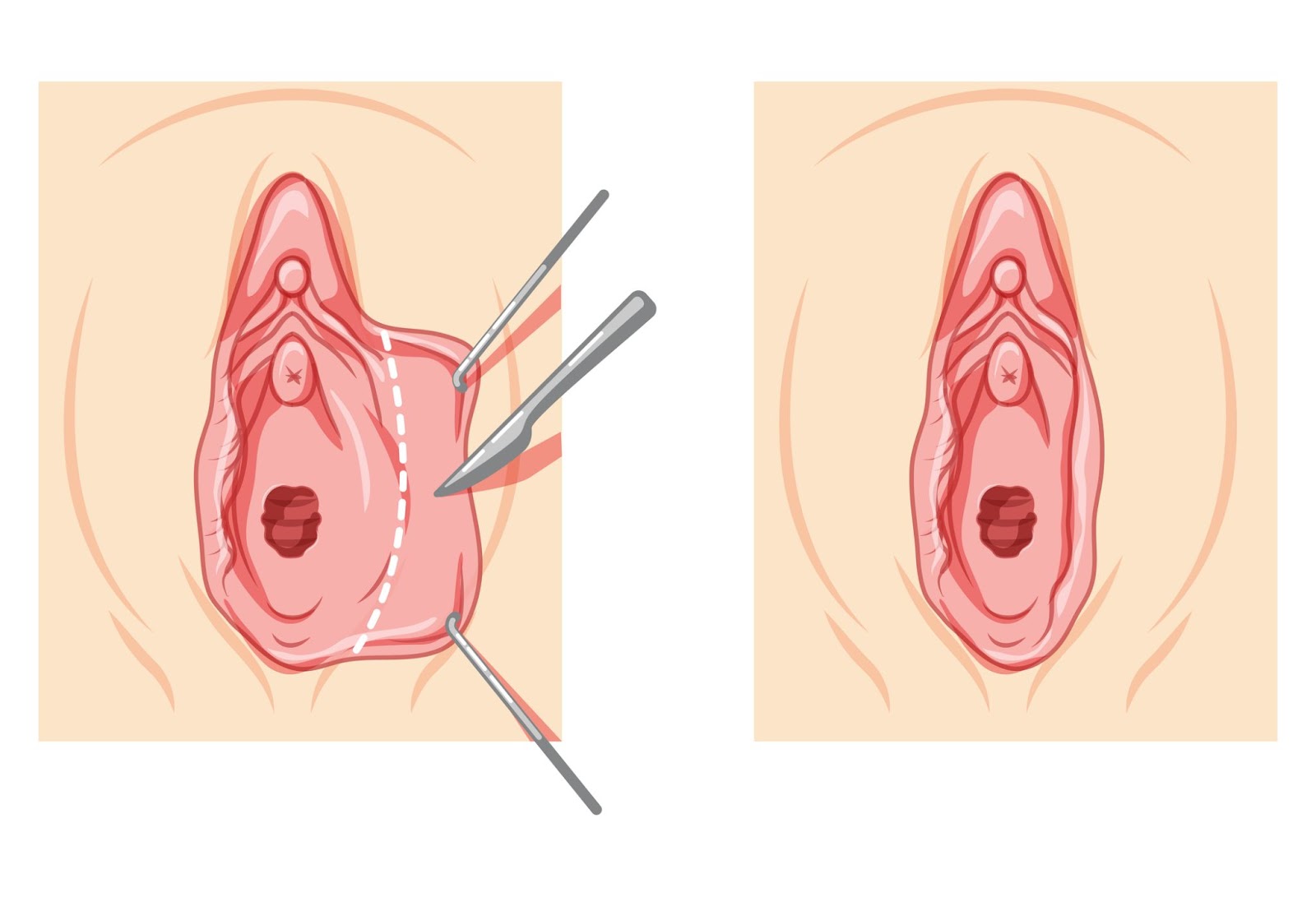 ¿Qué es la labioplastia?