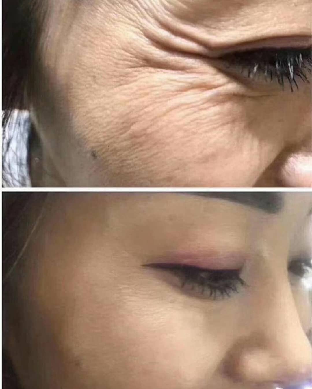 Results of Botox for removing wrinkles from the corner of the eyes