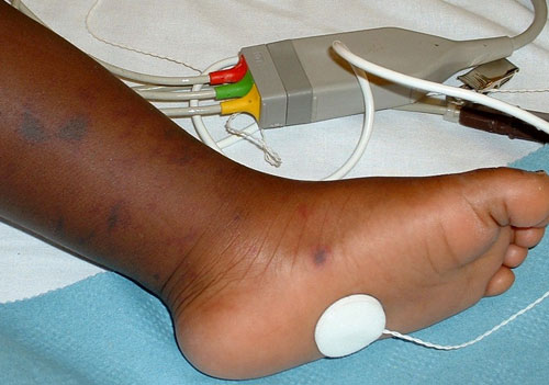 non blanching rash on dark skin