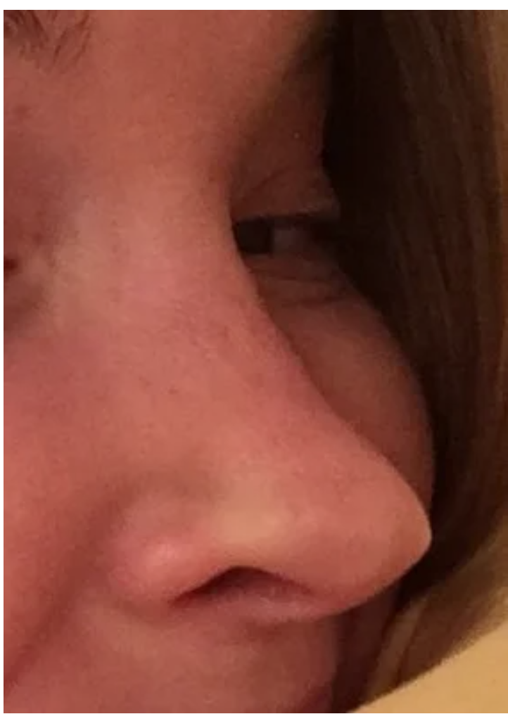 Dallas Rhinoplasty Center review