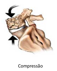 ilustração de uma fratura por compressão na coluna vertebral
legenda: 

