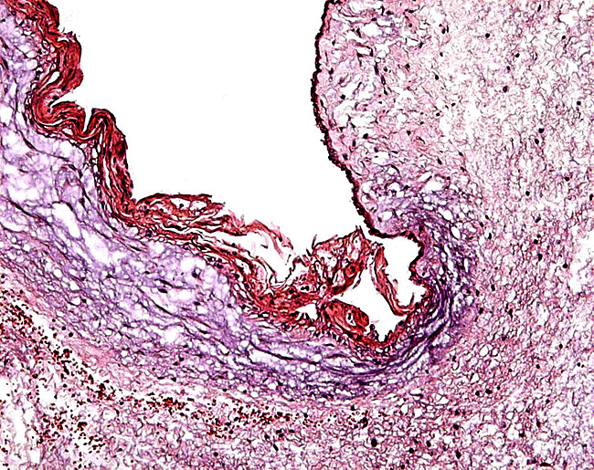Surface of the second placenta's umbilical cord