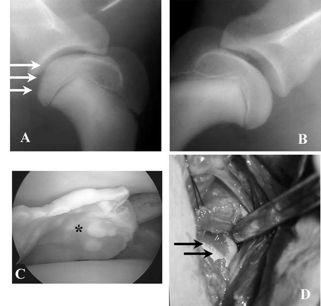 A series of images illustrating OCD of the caudal humeral head