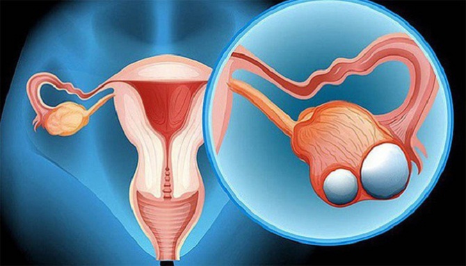 các giai đoạn ung thư buồng trứng,ung thư buồng trứng giai đoạn 1,ung thư buồng trứng giai đoạn 2,ung thư buồng trứng giai đoạn 3,ung thư buồng trứng giai đoạn cuối