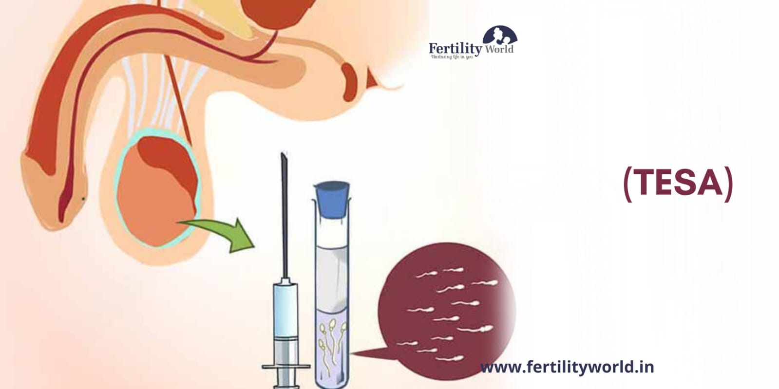 IVF with TESA treatment