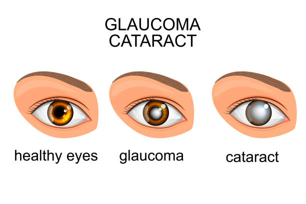 this image showing the different between the healthy eyes , glaucoma and cataract eye