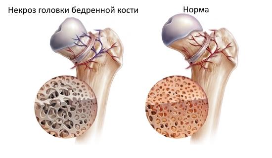 Асептический некроз — лечение в Ростове-на-Дону | Цены и отзывы