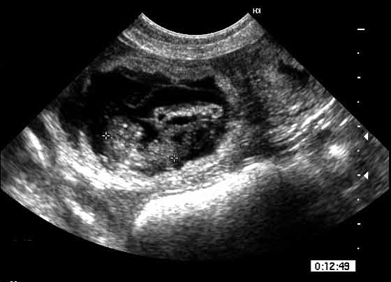 Embrión Día 32