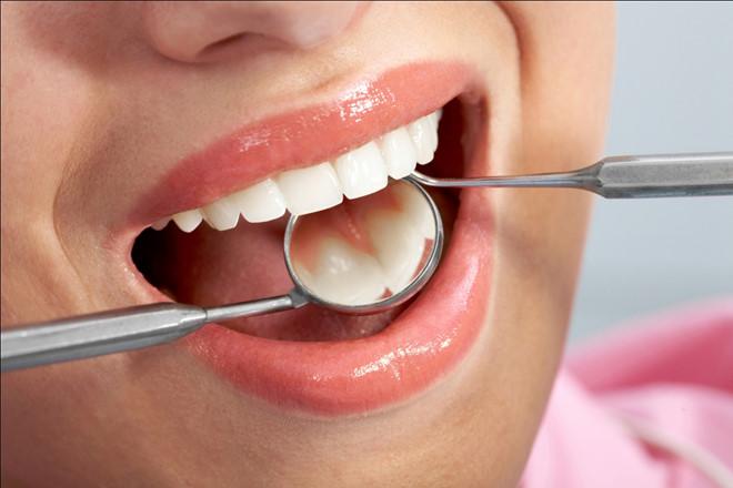 trám răng; trám răng thẩm mỹ, trám răng sâu