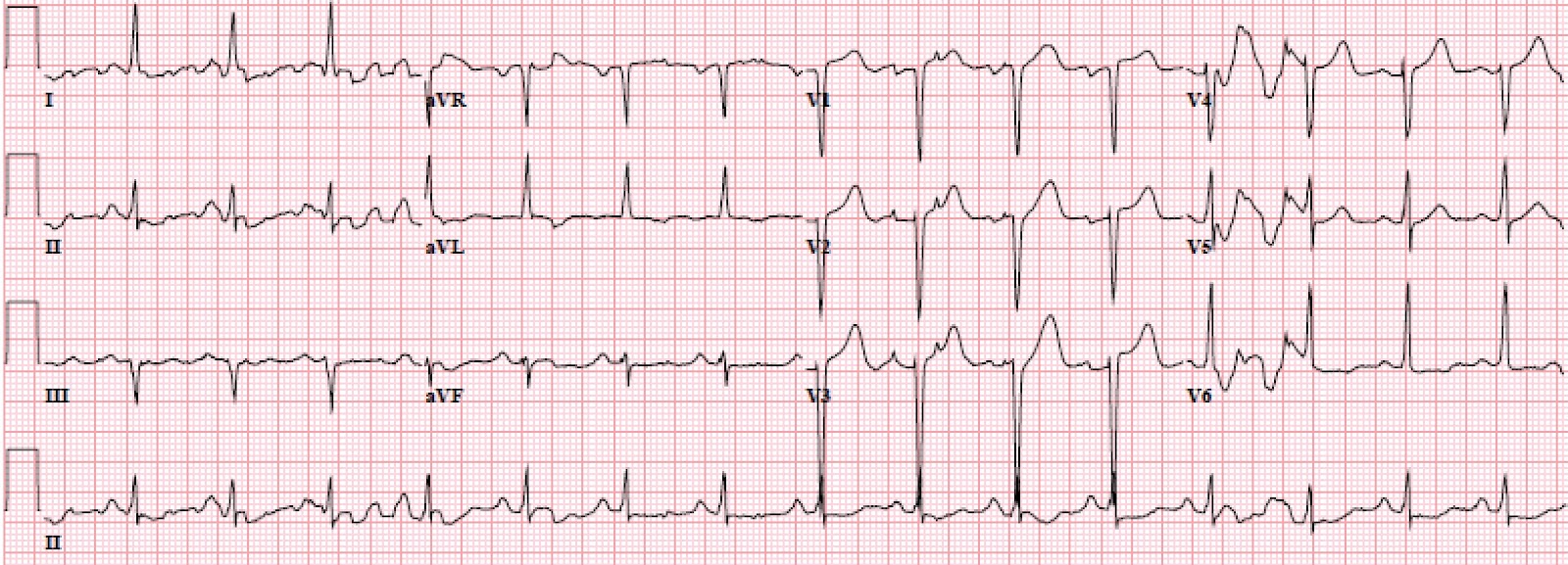 What is the meaning a poor R-wave progression in a cardiogram?