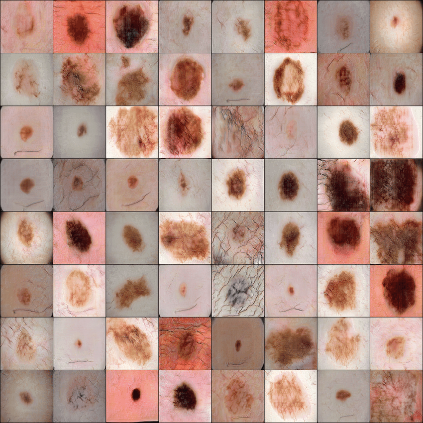 Synthetic medical data of skin lesions, generated with GANs