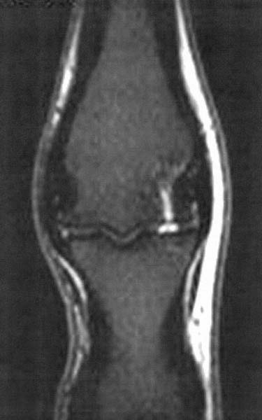 This is a coronal STIR image of a horse with a bone contusion of the distal third metatarsus; there is an area of high signal in the lateral condyle.