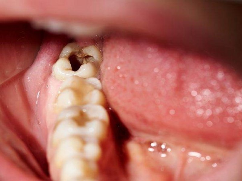 Dấu hiệu nhận biết sâu răng là những lỗ sâu trên bề mặt răng