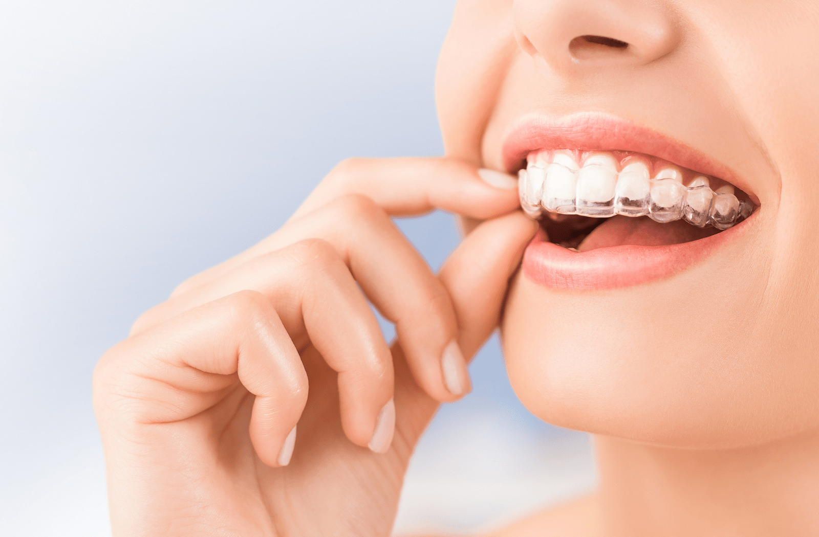 A woman placing Invisalign braces on her top teeth